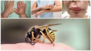 Reaktion på en hvepsestik hos et barn