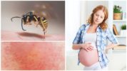 Wasp sting during pregnancy