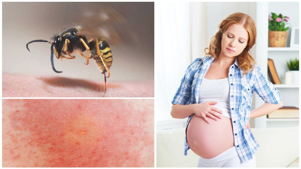 What to do if a wasp has bitten pregnant or breastfeeding