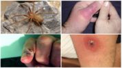 Les séquelles d'une morsure d'araignée ermite