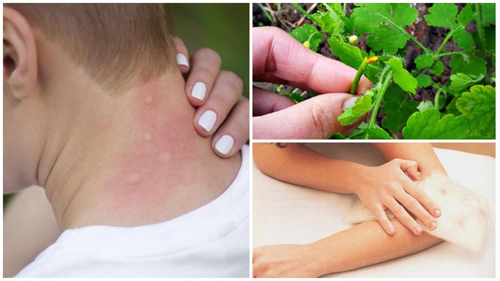 How and how to treat insect bites