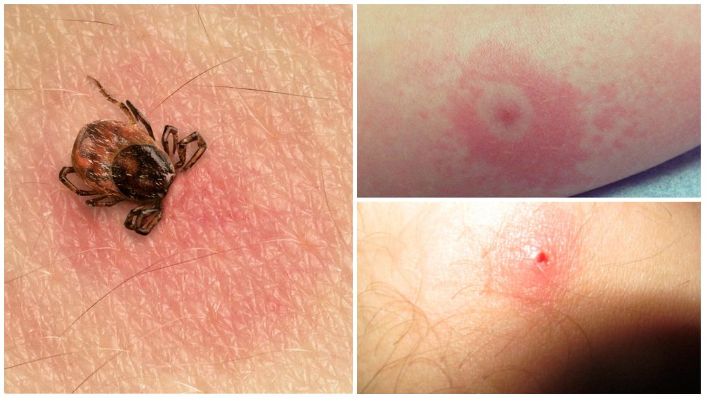 A lump appeared at the site of a tick bite: what to do