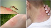 Morsure de moustique