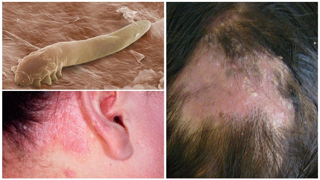 Symptômes et traitement de la démodécie du cuir chevelu