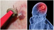 Tick-borne viral encephalitis