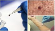 Removing a tick from the body