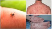Tick-borne and relapsing tick-borne typhus