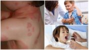 Treatment of borreliosis in children