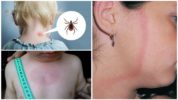 The first stage of borreliosis in a child