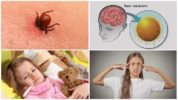 Signs of tick-borne encephalitis