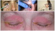 Behandlung der Augenliddemodikose