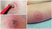 Lyme Tick Disease